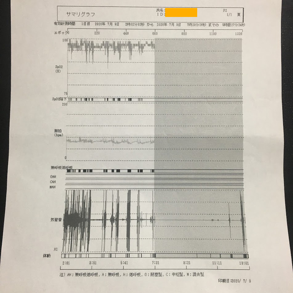 サマリグラフ睡眠時無呼吸症候群